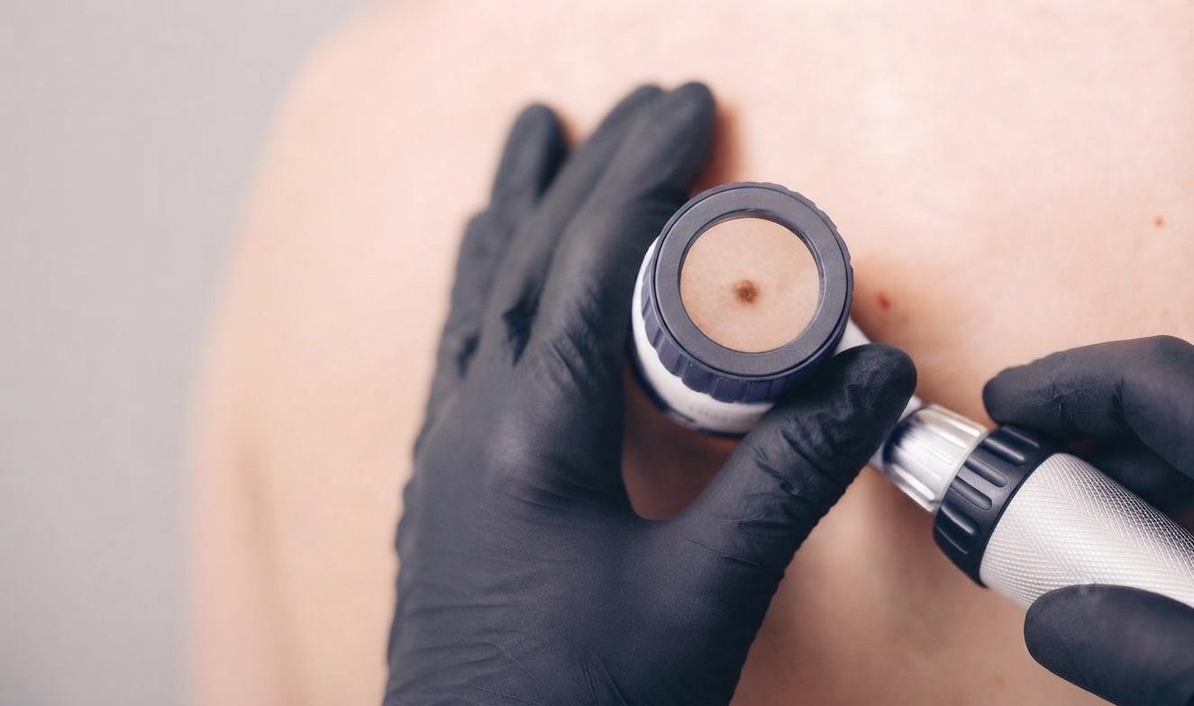 Dermatoscopie